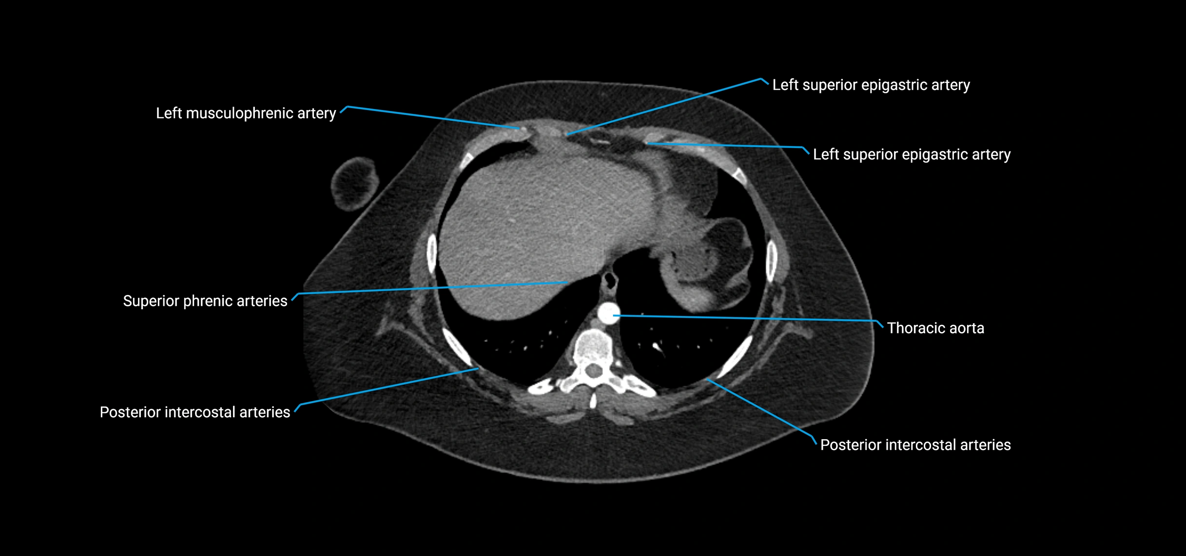 CTA abdomen axial cross sectional anatomy labelled image_17 (2).webp